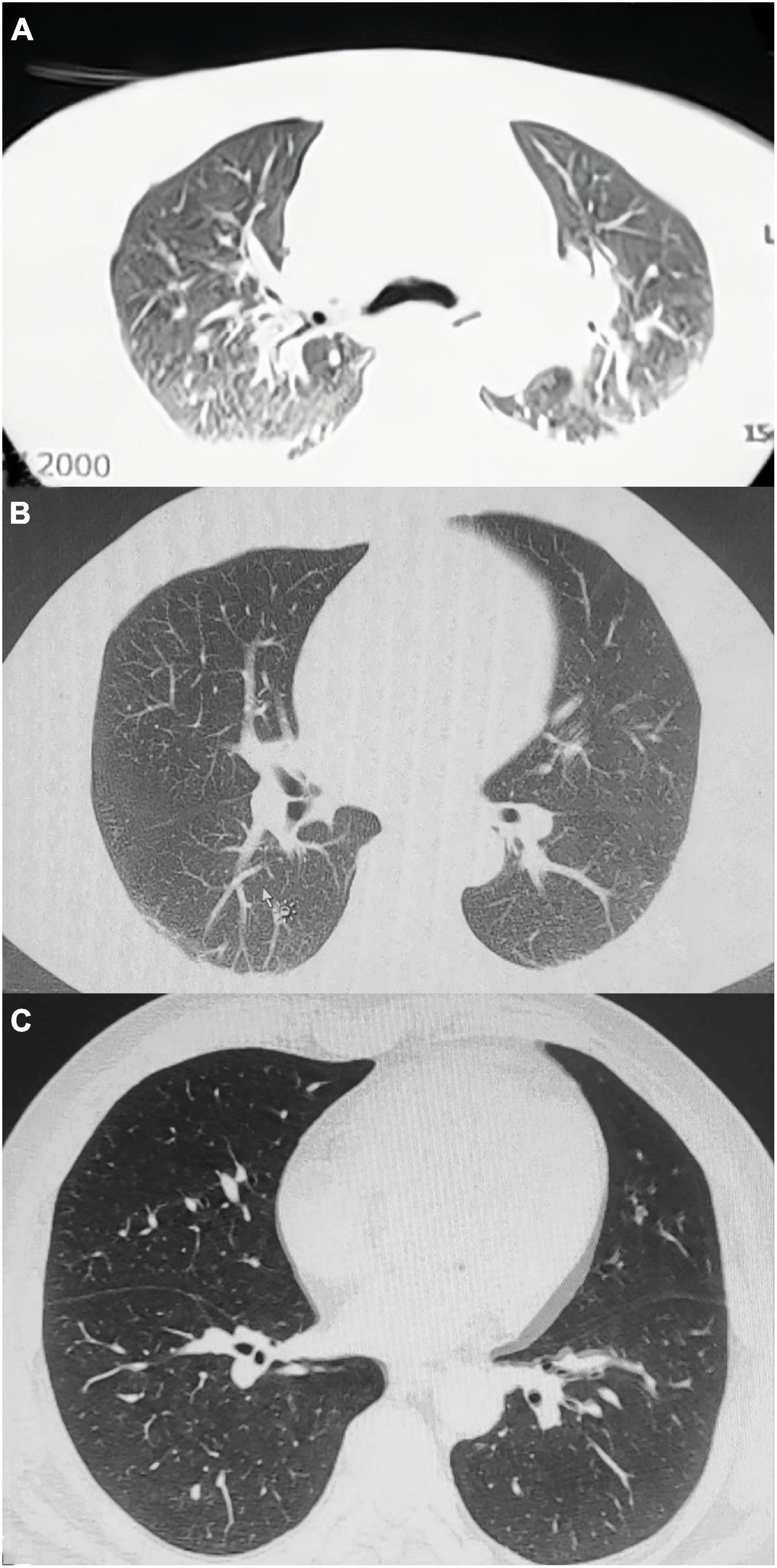 Case report: Methemoglobinemia caused by nitrobenzene poisoning